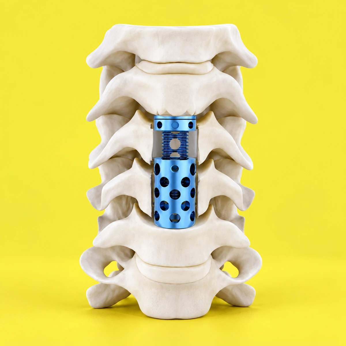Cervical cage assembly